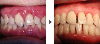 牙龈炎有何临床表现