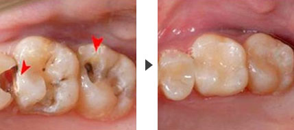 治疗龋齿有哪些方法
