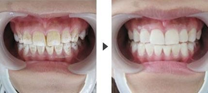氟斑牙如何选择合适的牙齿美白方法