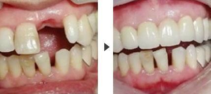 种植牙比传统假牙有哪些优势？