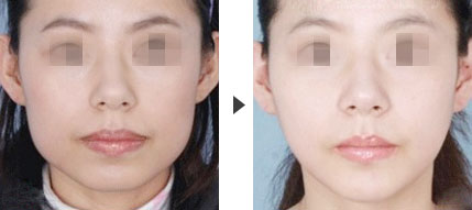 改脸型手术术前应该了解哪些?