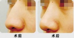 如何矫正驼峰鼻呢?手术方法有哪些?