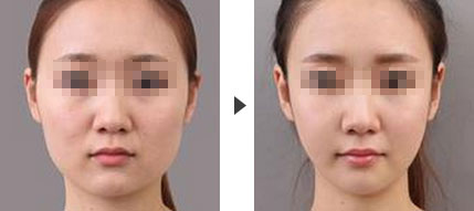 改脸型手术需要多久可以恢复正常