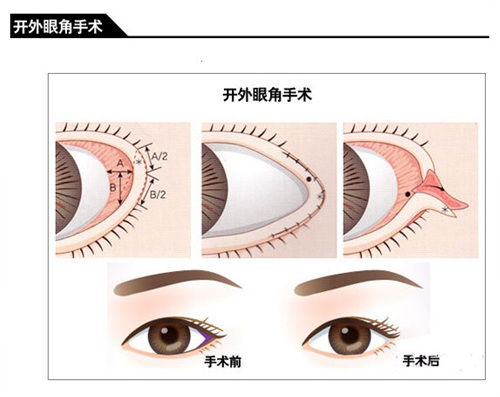 吉林市铭医开外眼角手术