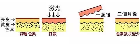 吉林市铭医整形美容医院激光祛雀斑