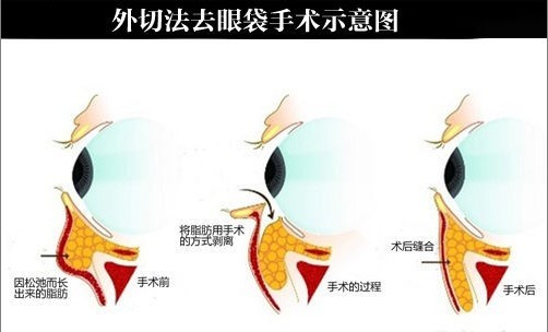 吉林市铭医整形美容医院祛眼袋