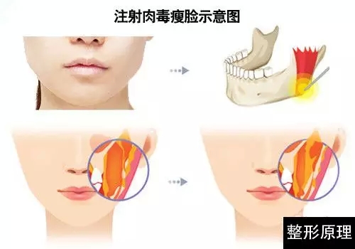 吉林市铭医整形美容医院瘦脸针