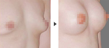 乳房再造术的效果怎么样?