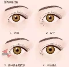 吉林市铭医整形美容医院开眼角