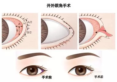 吉林市铭医整形美容医院开眼角手术