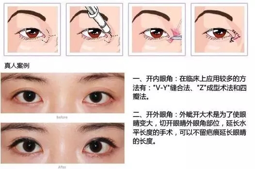 吉林市铭医整形美容医院开眼角手术