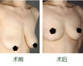 乳房下垂矫正,吉林市铭医整形,铭医整形美容医院,吉林好的整形医院,铭医整形医院