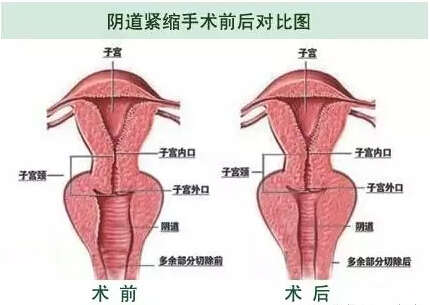 阴道紧缩,对比图,吉林市好的整形医院