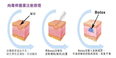 祛法令纹,肉毒素,对比图,吉林市好的整形医院