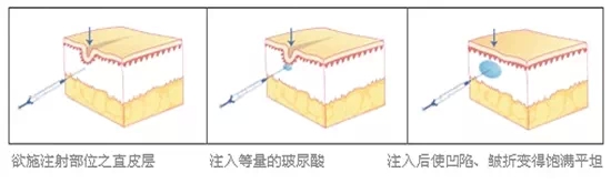 祛法令纹,玻尿酸,对比图,吉林市好的整形医院