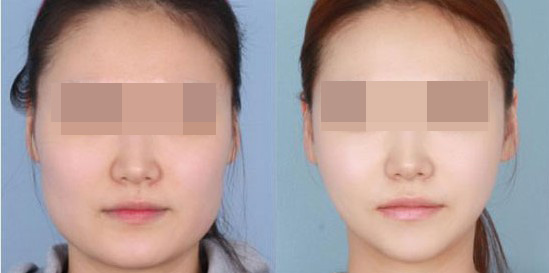 改脸型,吉林市铭医整形,铭医整形美容医院,吉林好的整形医院,铭医整形医院