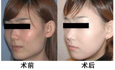 颧骨整形,吉林市铭医整形,铭医整形美容医院,吉林好的整形医院,铭医整形医院