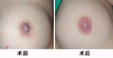 乳晕不再发黑 胸部更美更性感