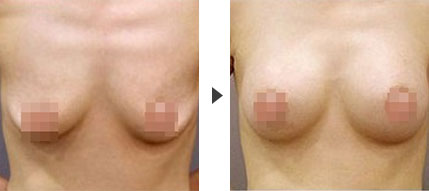 吉林市铭医整形乳房下垂矫正术的优势?