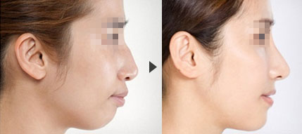 驼峰鼻矫正术可以保持多久呢?
